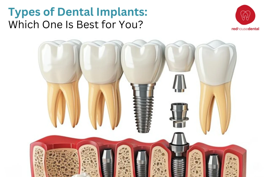 Types of dental implants guide - Red House Dental Richmond Hill