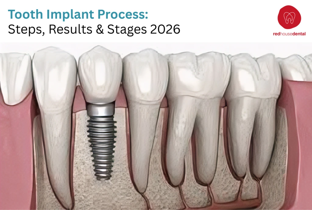 Tooth implant process guide - Red House Dental Richmond Hill